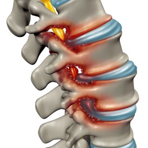 Spinal bone spurs impinging on a nerve root