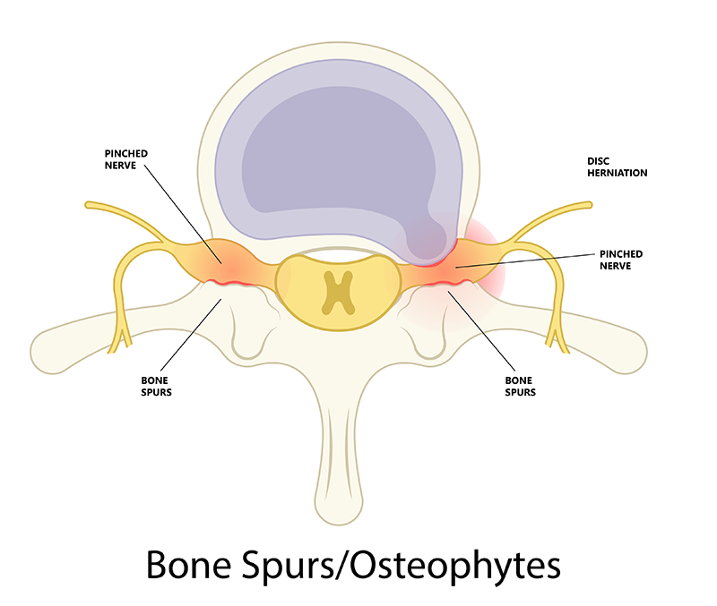 Osteophytes or bone spurs in lumbar spine