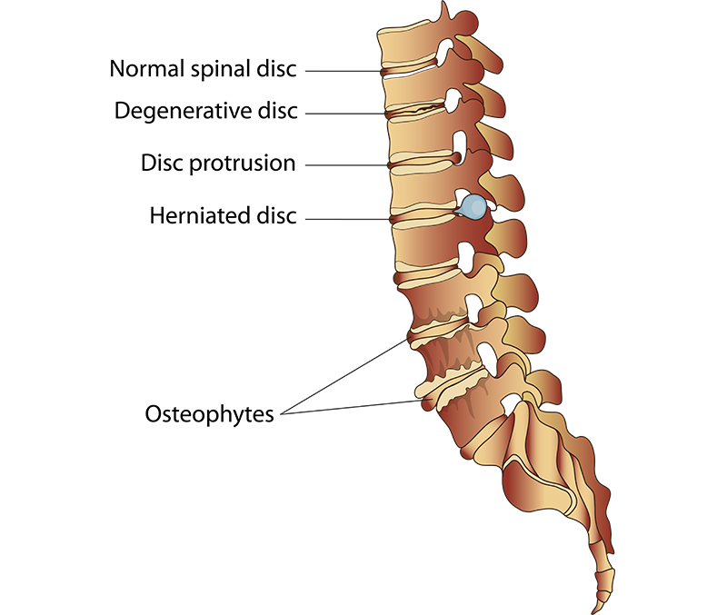 Degenerative Disc Disease of the lumbar spine