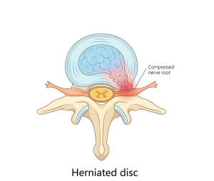 Herniated Disc