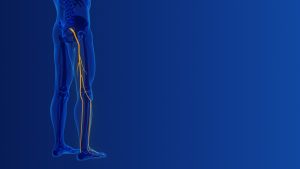Lumbar radiculopathy- Pain that radiates from the lower back to the legs