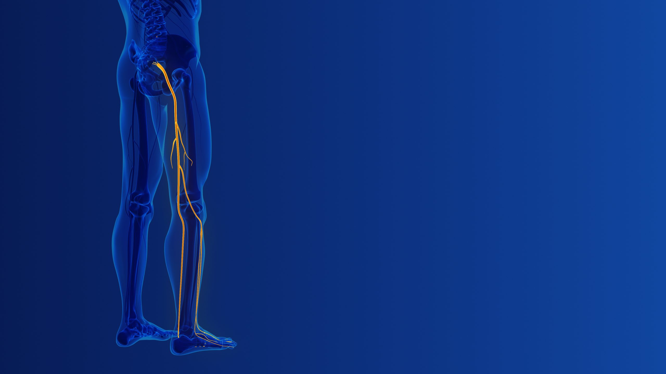 Illustration of a compressed nerve root exiting the lumbar spine