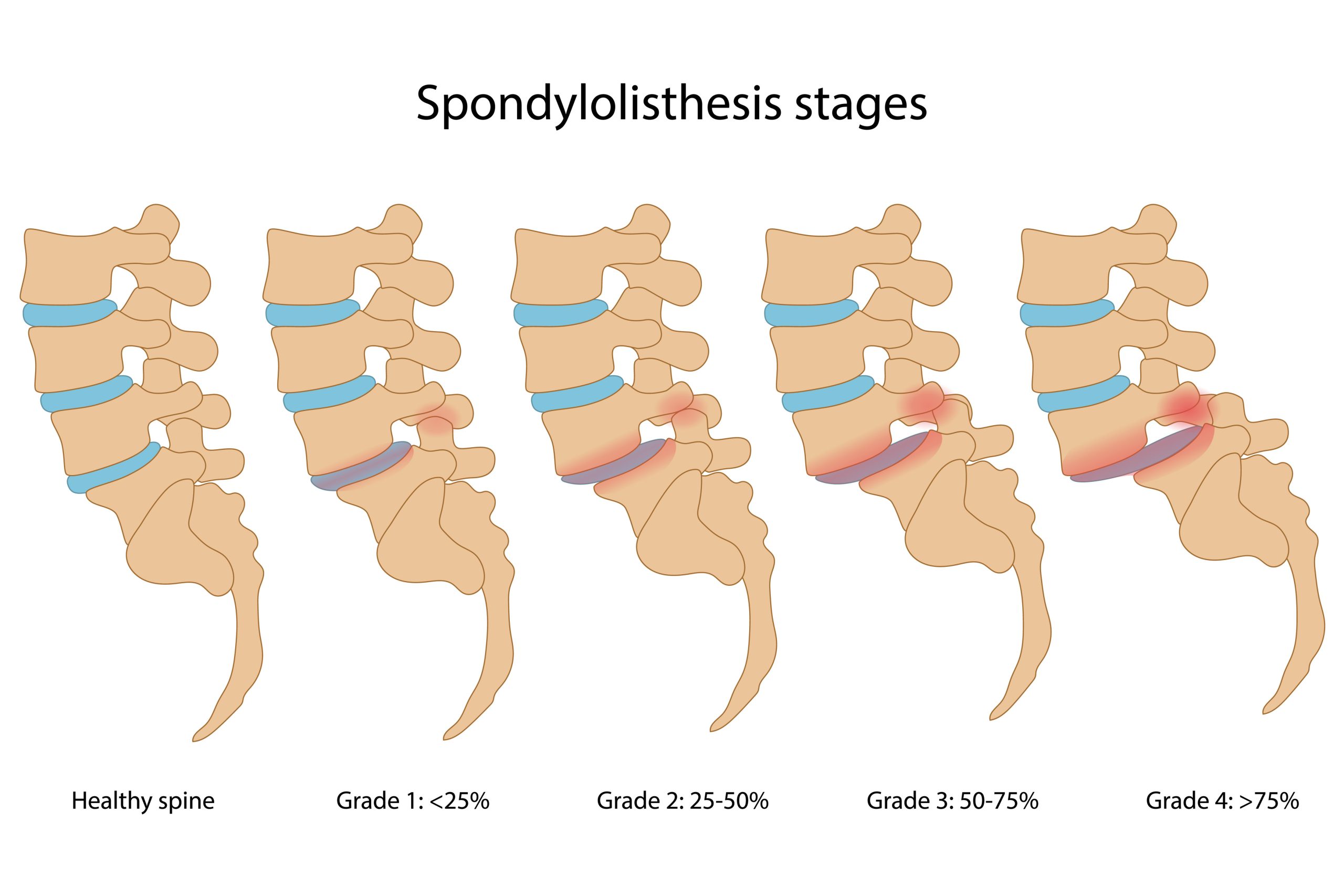 Spondylolisthesis Stages