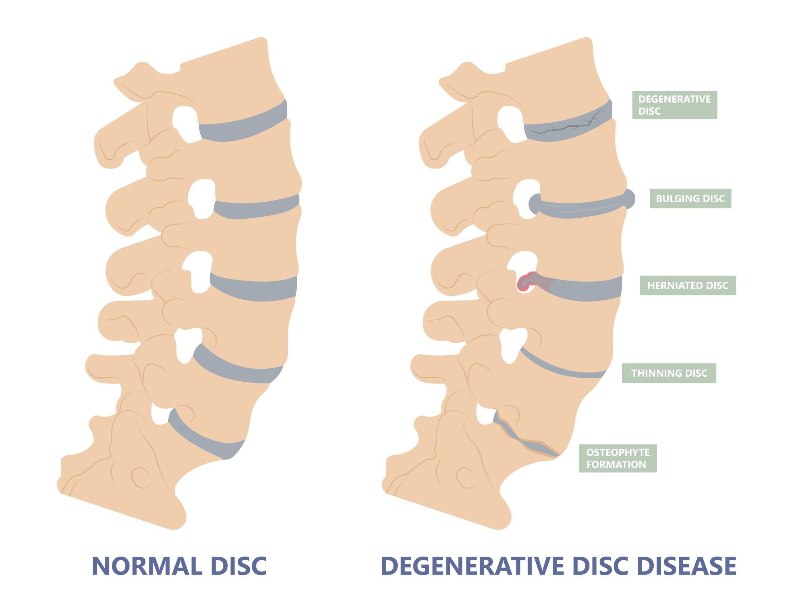 Illustration of spondylosis and degenerative changes of the spine