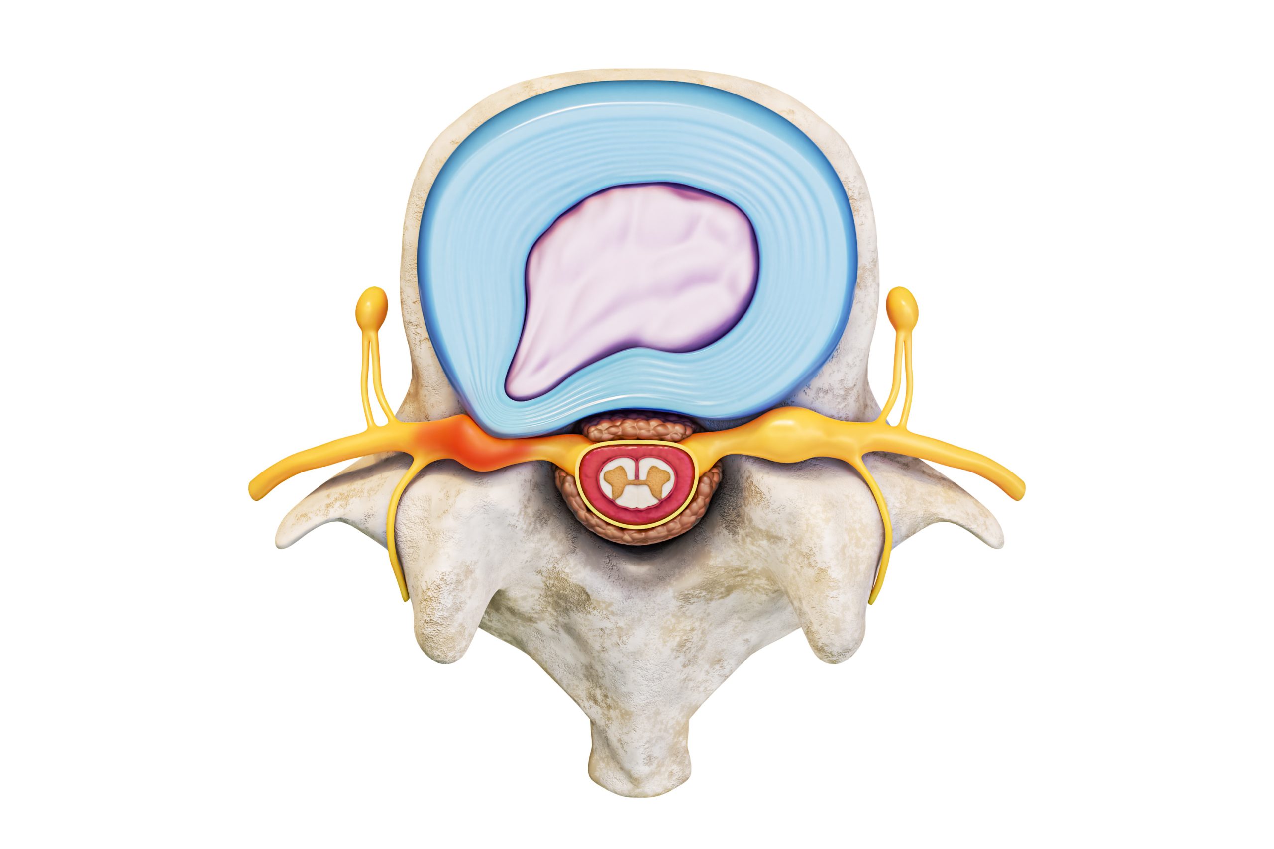 Cervical Radiculopathy Diagram