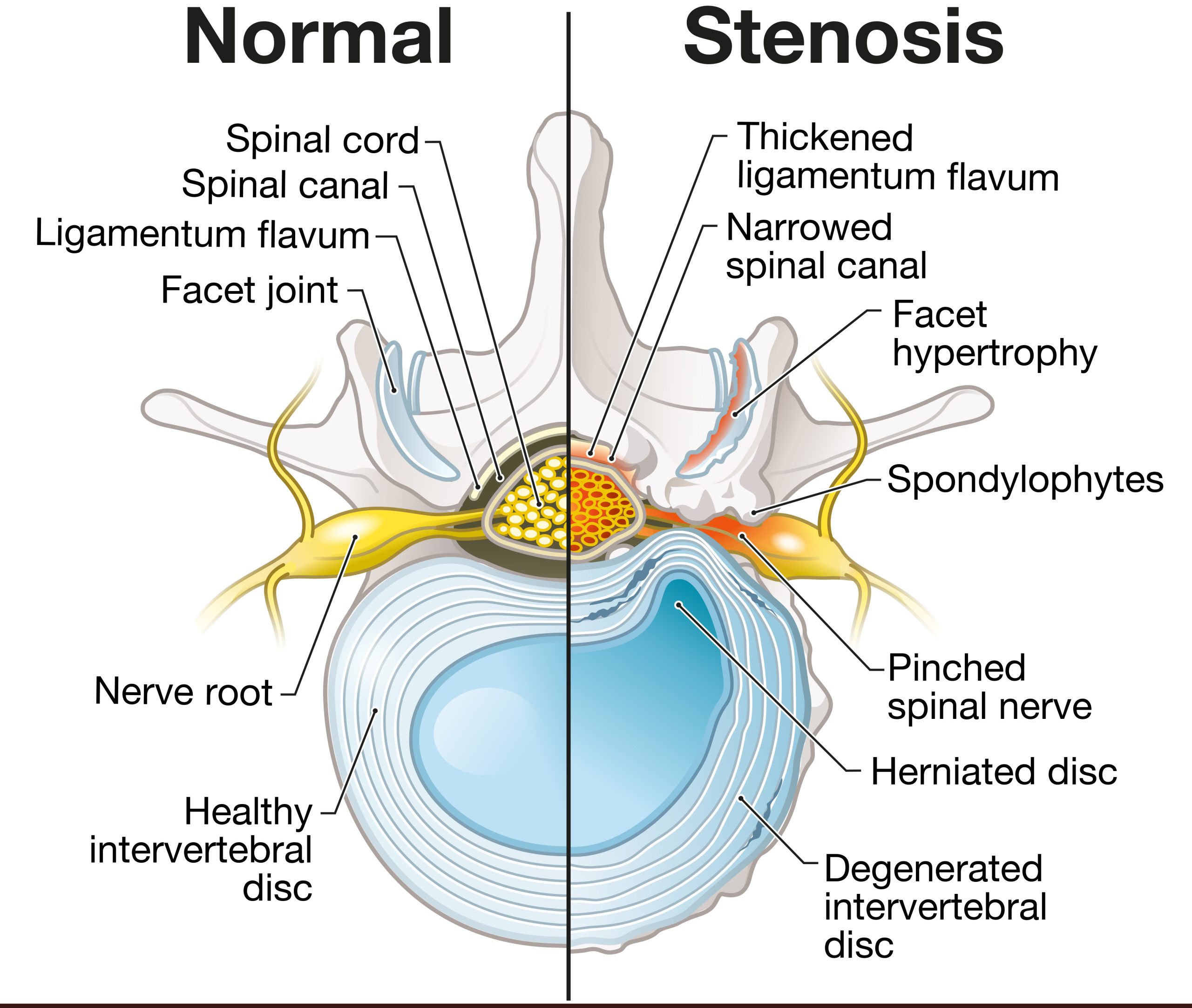Cervical Radiculopathy Diagram